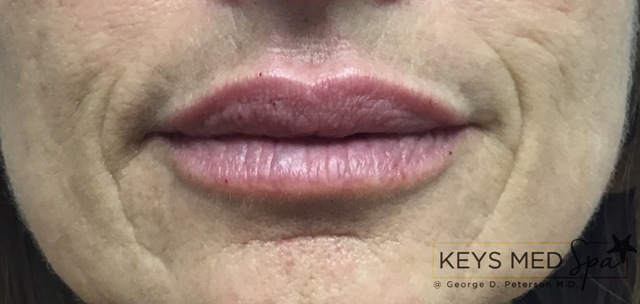 after lip fillers