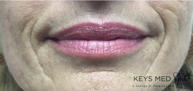 before lip fillers