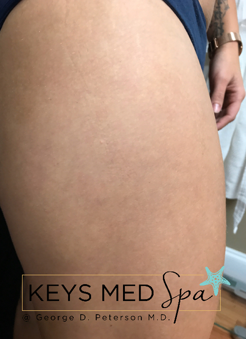 smoother thighs after CoolSculpting