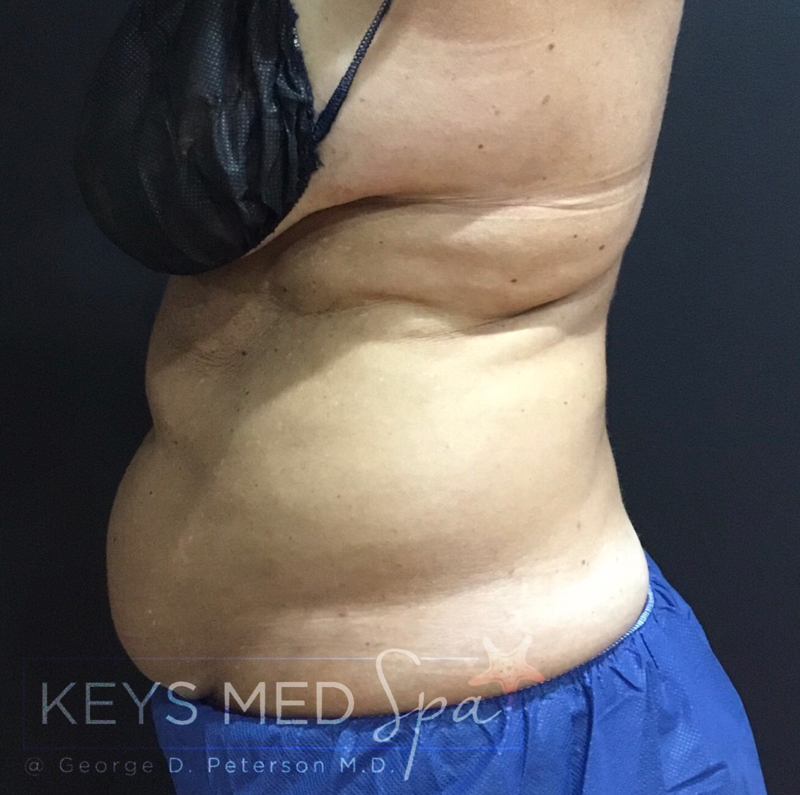 female patient's abdomen before coolsculpting